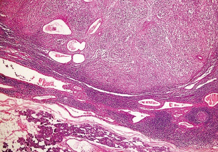 Diffuse Large B-Cell Lymphoma Arising in Warthin's Tumor: Case Study and Review of the Literature.