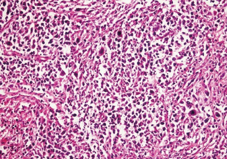 Diffuse Large B-Cell Lymphoma Arising in Warthin's Tumor: Case Study and Review of the Literature.