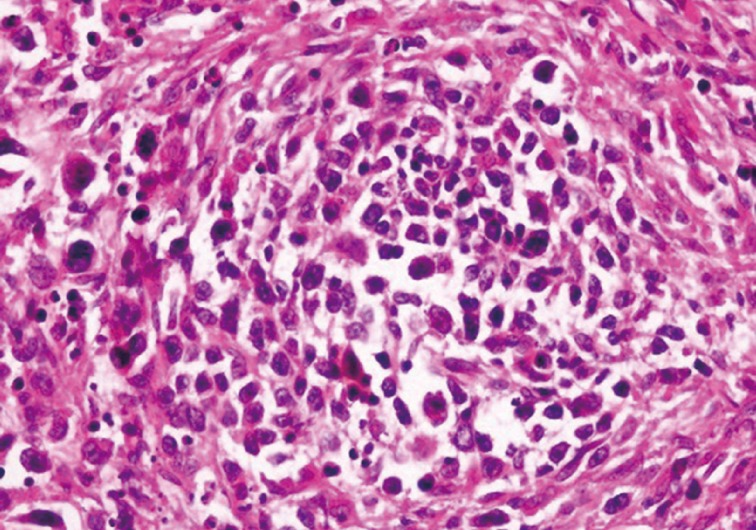 Diffuse Large B-Cell Lymphoma Arising in Warthin's Tumor: Case Study and Review of the Literature.