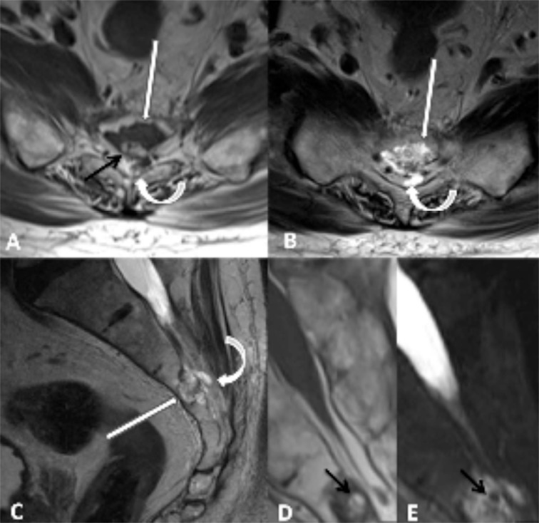 Benign Notochordal Cell Tumor of the Sacrum with Atypical Imaging Features: The Value of CT Guided Biopsy for Diagnosis.