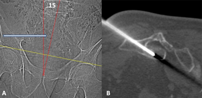 Benign Notochordal Cell Tumor of the Sacrum with Atypical Imaging Features: The Value of CT Guided Biopsy for Diagnosis.