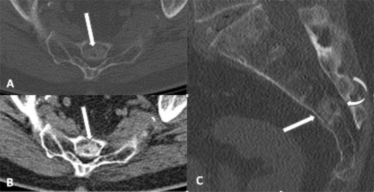 Benign Notochordal Cell Tumor of the Sacrum with Atypical Imaging Features: The Value of CT Guided Biopsy for Diagnosis.