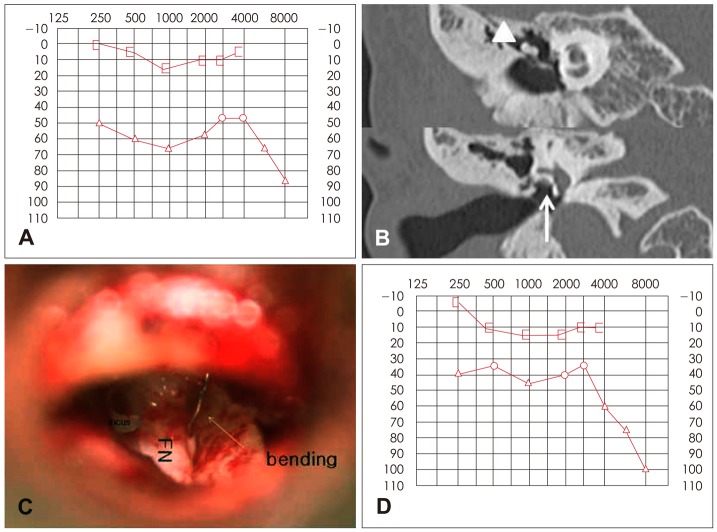 Two cases of malleostapedotomy in congenital oval window atresia.