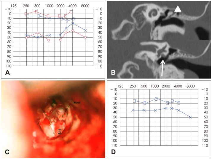 Two cases of malleostapedotomy in congenital oval window atresia.
