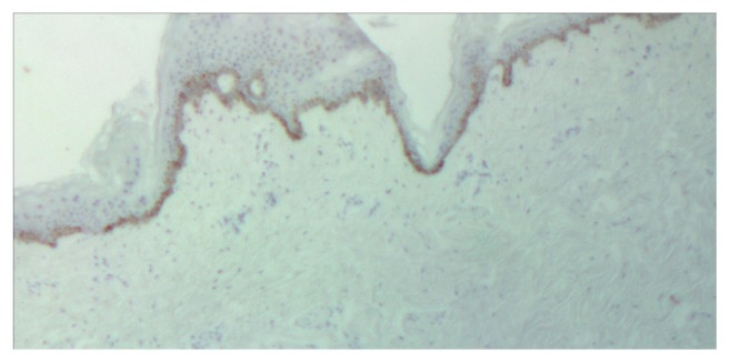 Immunohistochemical studies of the kynurenine pathway in morphea.