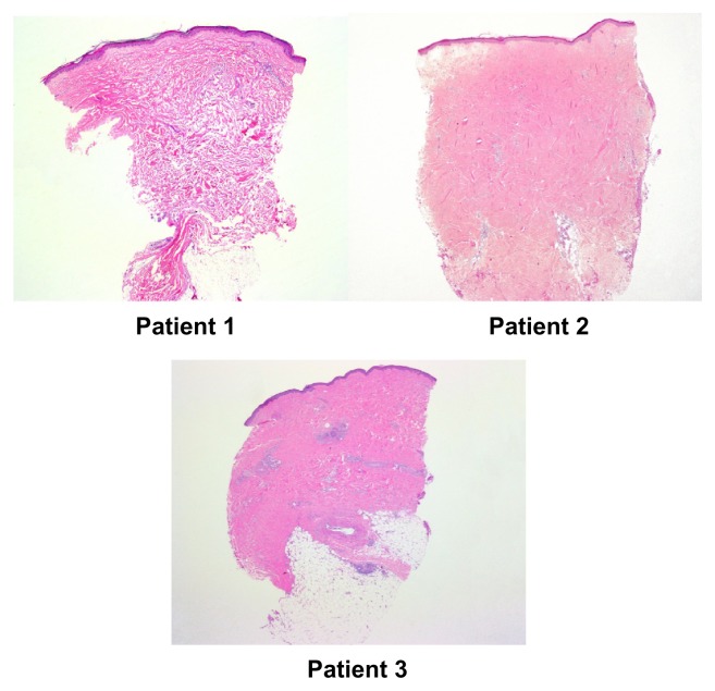 Immunohistochemical studies of the kynurenine pathway in morphea.