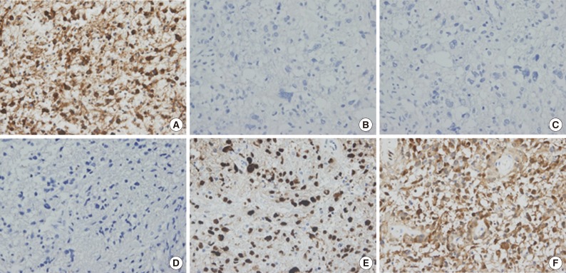 Immunohistochemical classification of primary and secondary glioblastomas.