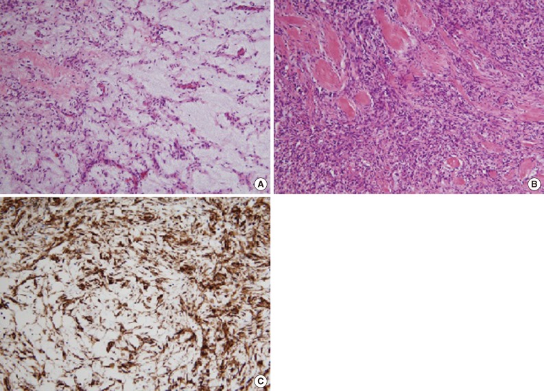 Myxoid solitary fibrous tumor of the central nervous system.