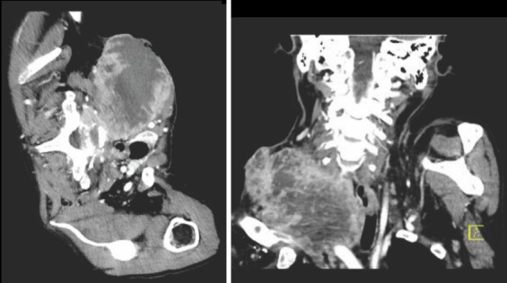 Surgical errors and risks - the head and neck cancer patient.