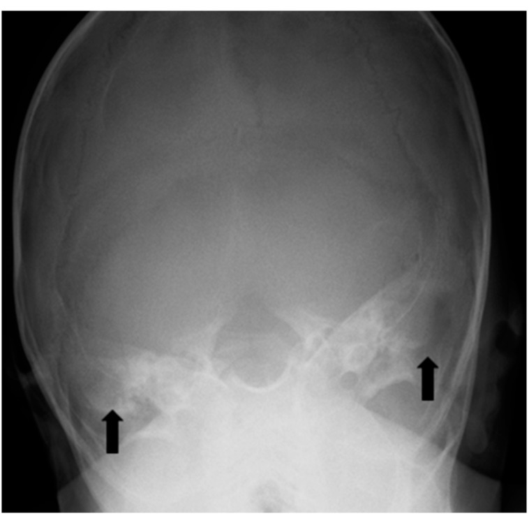 Bilateral temporal bone langerhans cell histiocytosis: radiologic pearls.