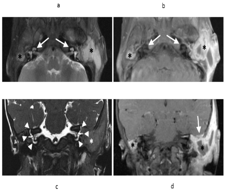 Bilateral temporal bone langerhans cell histiocytosis: radiologic pearls.