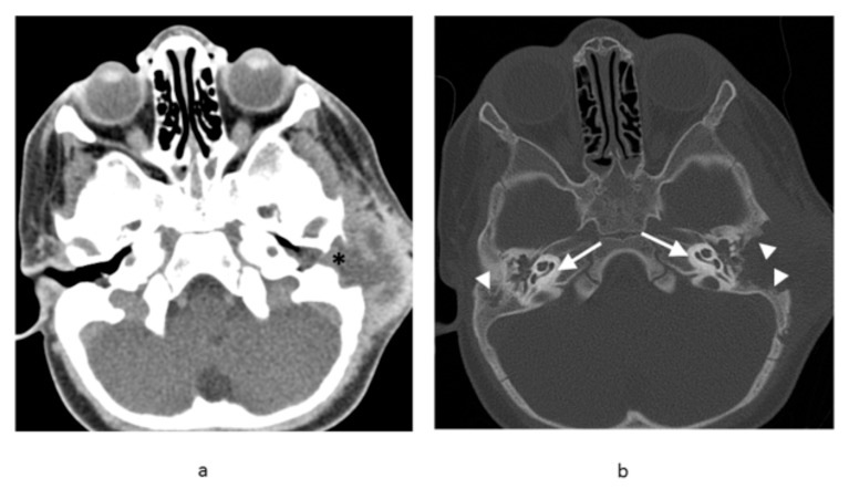 Bilateral temporal bone langerhans cell histiocytosis: radiologic pearls.