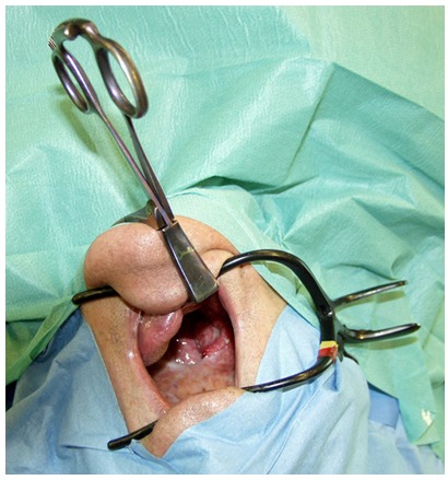 Surgical errors and risks - the head and neck cancer patient.