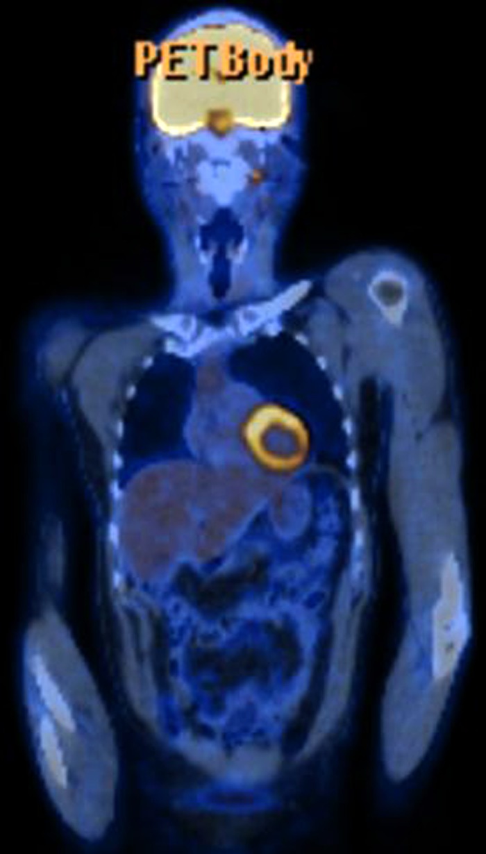 Diabetes insipidus, a pituitary stalk lesion and fluorodeoxyglucose-positron emission tomography scanning.