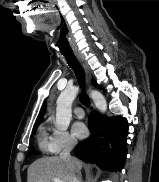 Diabetes insipidus, a pituitary stalk lesion and fluorodeoxyglucose-positron emission tomography scanning.