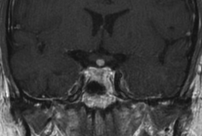 Diabetes insipidus, a pituitary stalk lesion and fluorodeoxyglucose-positron emission tomography scanning.