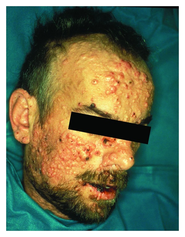 New Insights into HIV/AIDS-Associated Cryptococcosis.