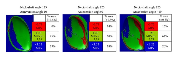 Femoral neck version affects medial femorotibial loading.