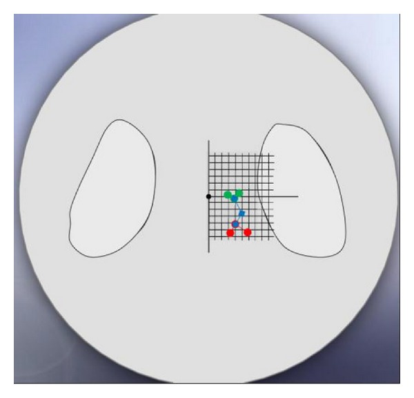 Femoral neck version affects medial femorotibial loading.