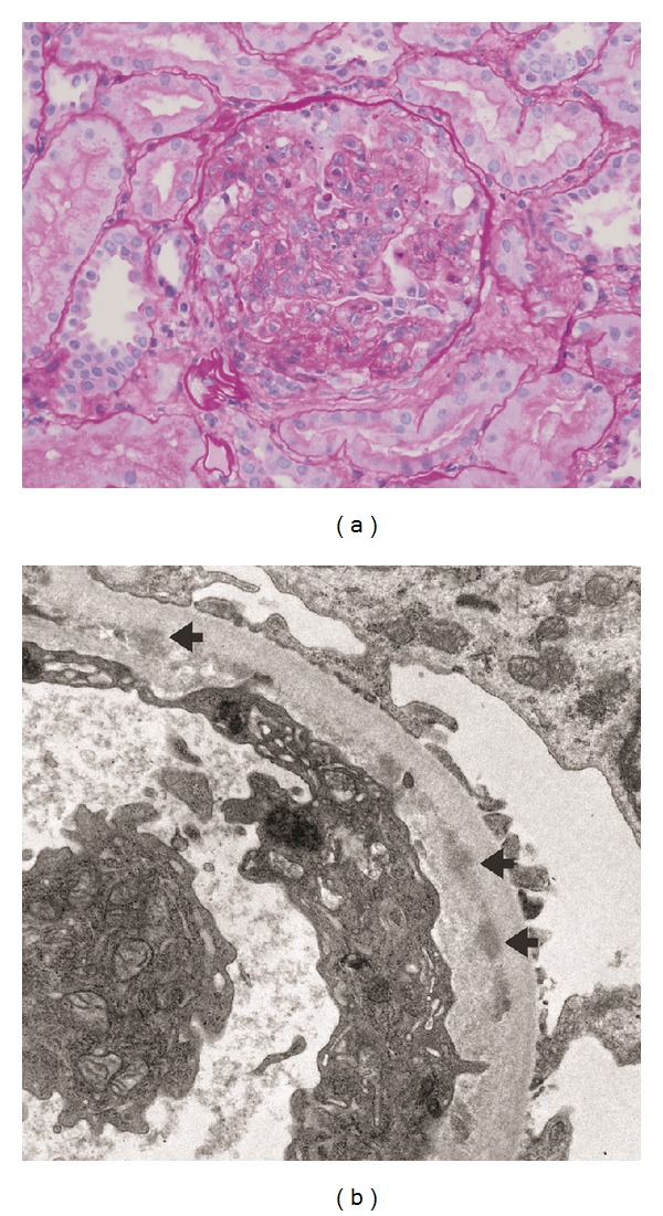 Glomerular disease in patients with infectious processes developing antineutrophil cytoplasmic antibodies.