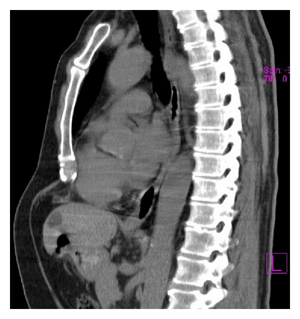 Symptomatic pectus excavatum in seniors: an exploratory study on clinical presentation and incidence in daily practice.