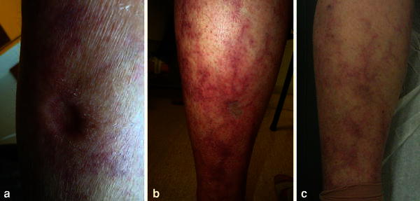 Intravenous immunoglobulin therapy in vasculitic ulcers: a case of polyarteritis nodosa.