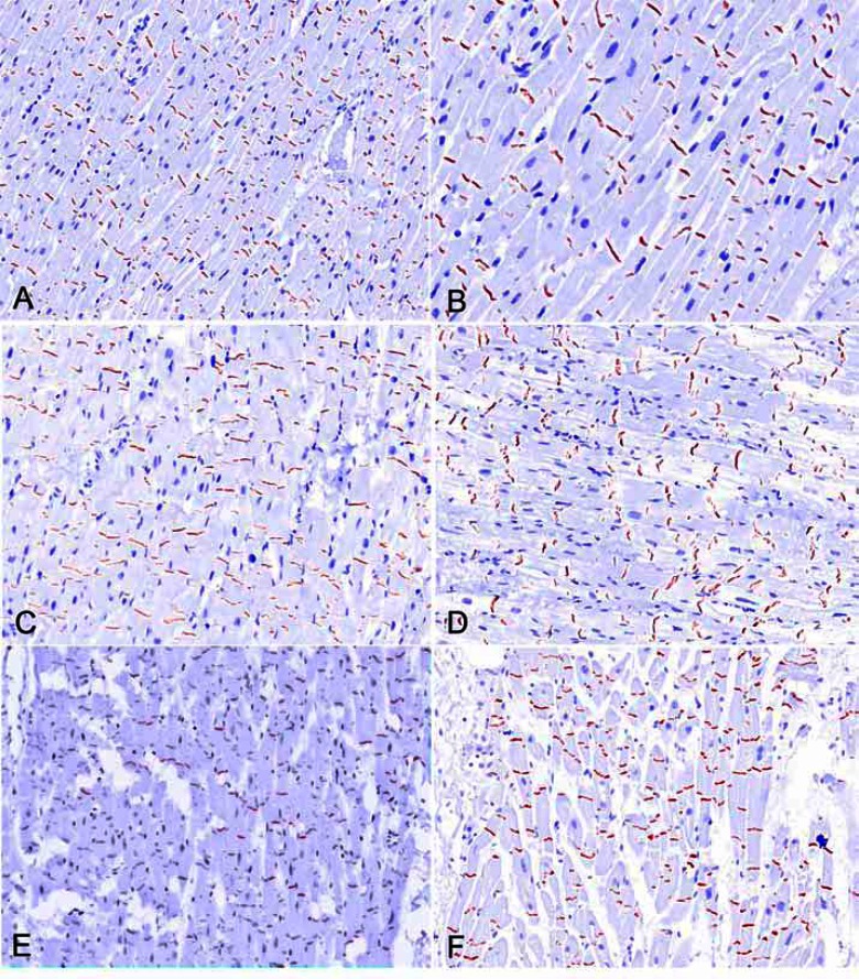 Quantitative Immunohistochemistry of Desmosomal Proteins (Plakoglobin, Desmoplakin and Plakophilin), Connexin-43, and N-cadherin in Arrhythmogenic Cardiomyopathy: An Autopsy Study.