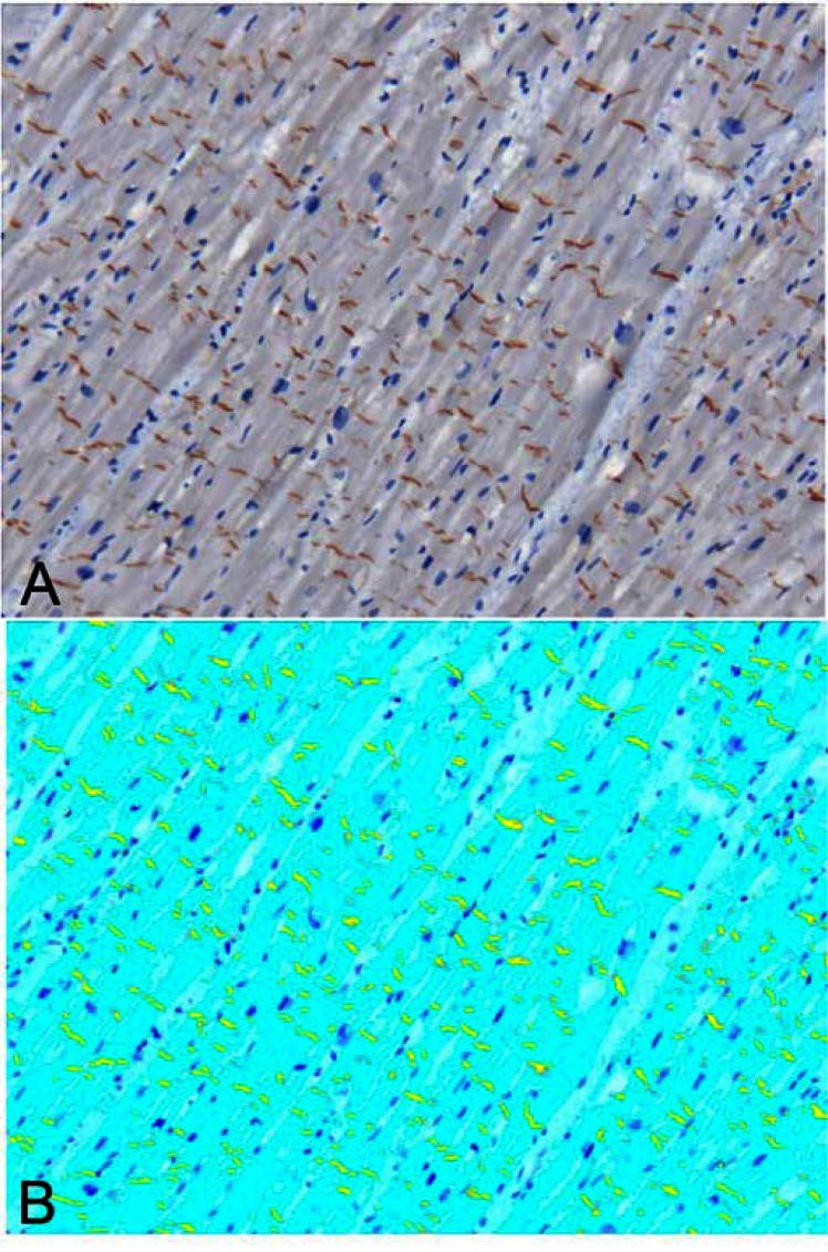 Quantitative Immunohistochemistry of Desmosomal Proteins (Plakoglobin, Desmoplakin and Plakophilin), Connexin-43, and N-cadherin in Arrhythmogenic Cardiomyopathy: An Autopsy Study.
