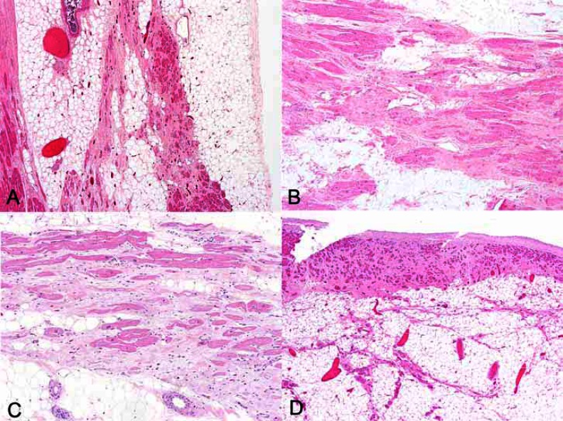 Quantitative Immunohistochemistry of Desmosomal Proteins (Plakoglobin, Desmoplakin and Plakophilin), Connexin-43, and N-cadherin in Arrhythmogenic Cardiomyopathy: An Autopsy Study.