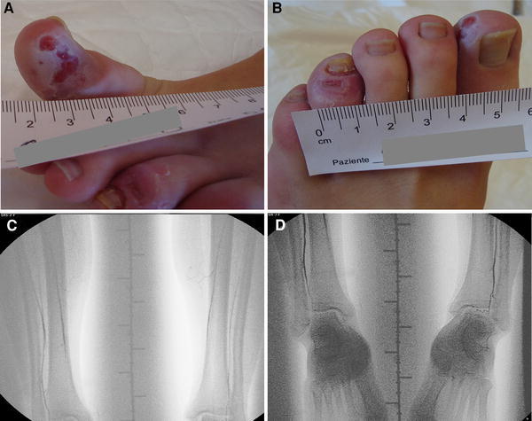 Arterial occlusion mimicking vasculitis in a patient with incontinentia pigmenti.