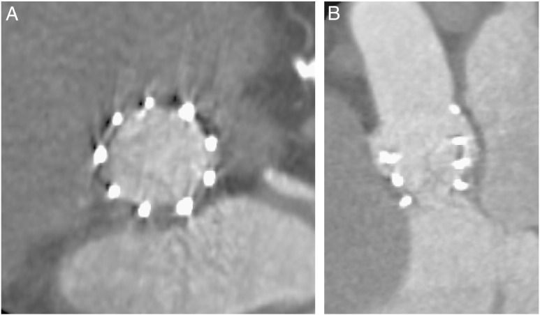 Early transcatheter heart valve thrombosis detected by multidetector computed tomography