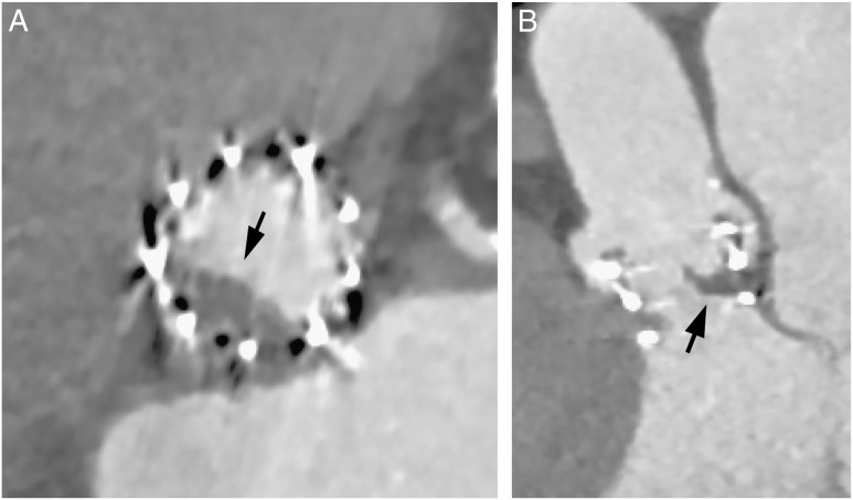 Early transcatheter heart valve thrombosis detected by multidetector computed tomography