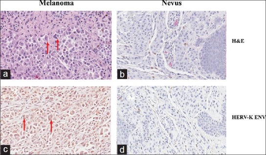 Human endogenous retroviral K element encodes fusogenic activity in melanoma cells.