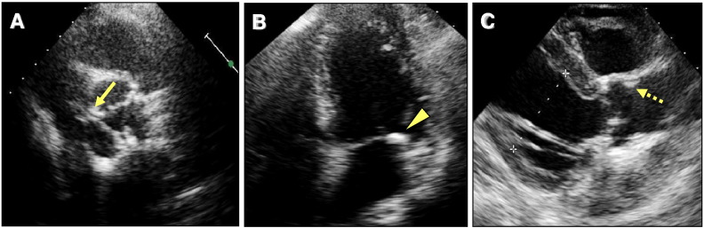 Association between heart calcification assessed by echocardiography and future cardiovascular disease mortality and morbidity