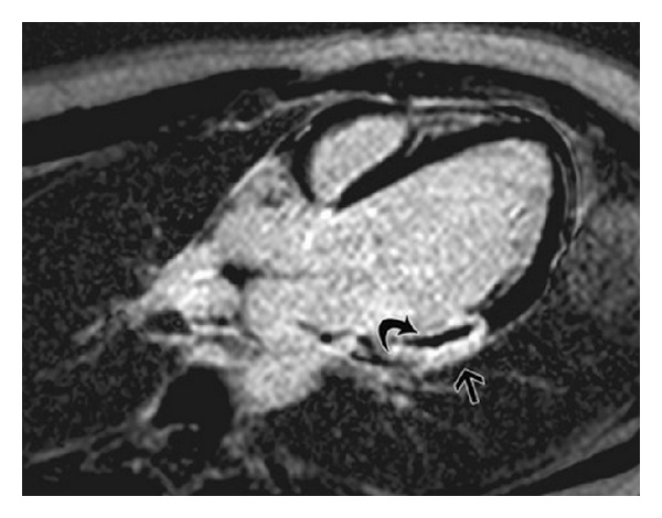 Intracoronary adenosine versus intravenous adenosine during primary PCI for ST-elevation myocardial infarction: which one offers better outcomes in terms of microvascular obstruction?