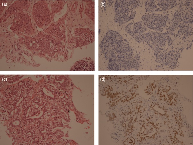 Primary adenocarcinoma of the lung with a synchronous carcinoid tumour of the small intestine.