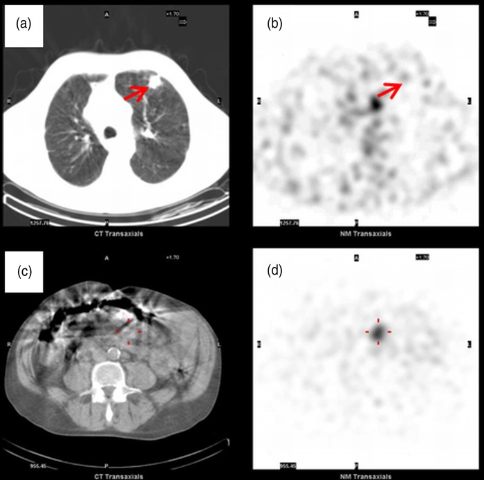 Primary adenocarcinoma of the lung with a synchronous carcinoid tumour of the small intestine.