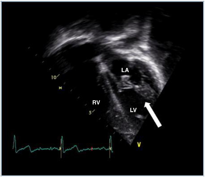 Cardiac disease in children and young adults with various lysosomal storage diseases: Comparison of echocardiographic and ECG changes among clinical groups