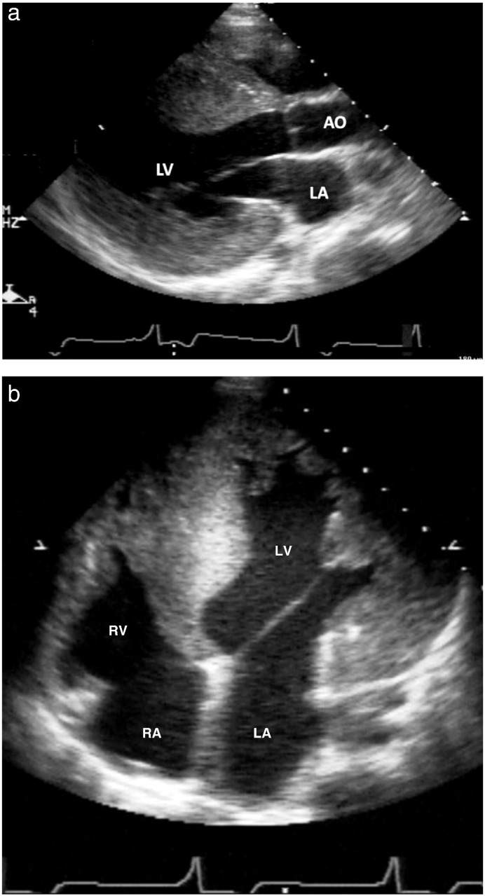 Cardiac disease in children and young adults with various lysosomal storage diseases: Comparison of echocardiographic and ECG changes among clinical groups