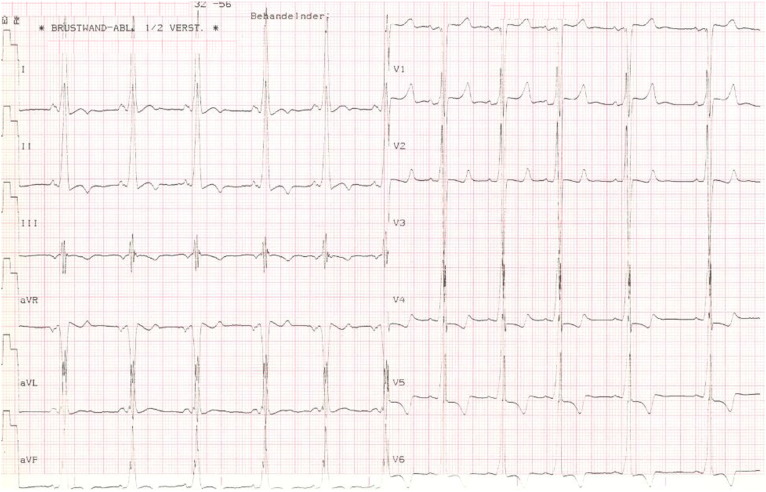 Cardiac disease in children and young adults with various lysosomal storage diseases: Comparison of echocardiographic and ECG changes among clinical groups