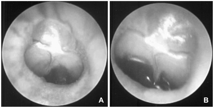 Development of animal models of otitis media.
