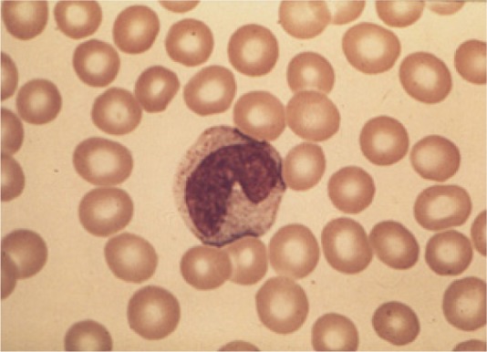 Idiopathic thrombocytopenia with iron deficiency anemia.