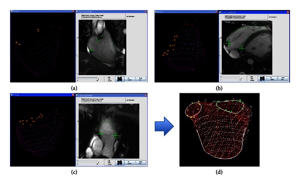 The Transaxial Orientation Is Superior to Both the Short Axis and Horizontal Long Axis Orientations for Determining Right Ventricular Volume and Ejection Fraction Using Simpson's Method with Cardiac Magnetic Resonance.