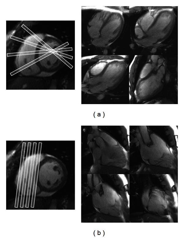 The Transaxial Orientation Is Superior to Both the Short Axis and Horizontal Long Axis Orientations for Determining Right Ventricular Volume and Ejection Fraction Using Simpson's Method with Cardiac Magnetic Resonance.