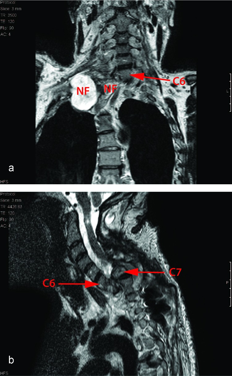 Vascularized fibula strut graft used in neurofibromatosis type 1-related kyphosis: a case of almost complete reversal of deformity-induced tetraparesis.