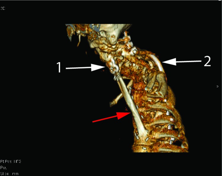 Vascularized fibula strut graft used in neurofibromatosis type 1-related kyphosis: a case of almost complete reversal of deformity-induced tetraparesis.