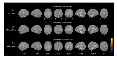 Dysfunctional cortical connectivity during the auditory oddball task in patients with schizophrenia.