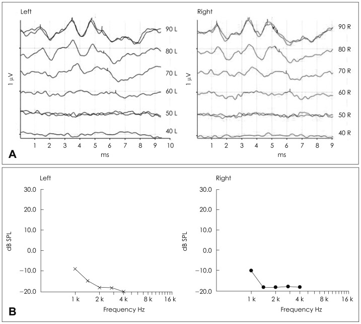A case of bilateral sudden hearing loss and tinnitus after salicylate intoxication.