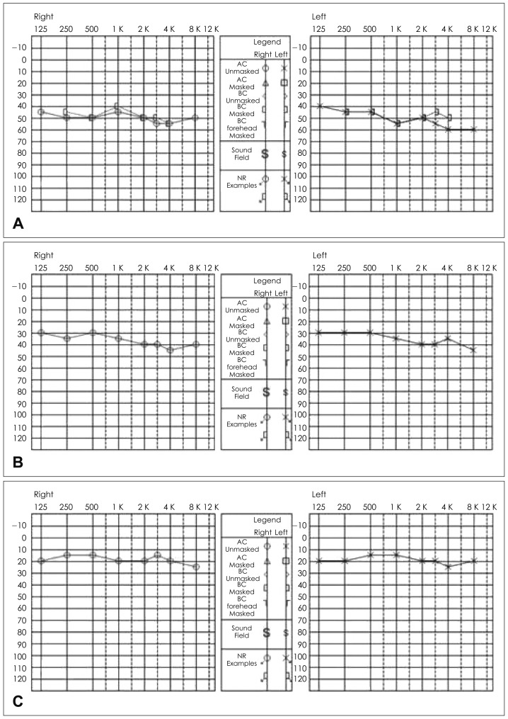 A case of bilateral sudden hearing loss and tinnitus after salicylate intoxication.