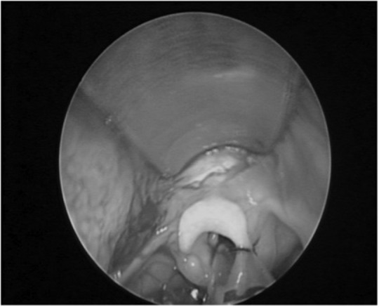 Vallecular cysts: a differential diagnosis to consider for neonatal stridor and failure to thrive.